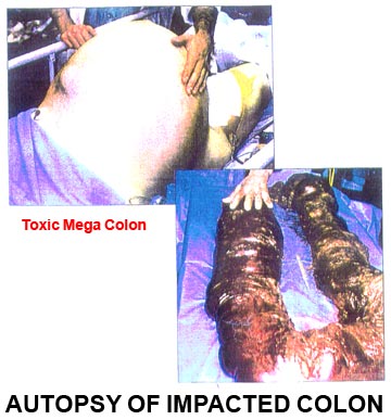 toxic_colon